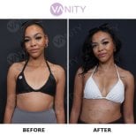 Before and after breast augmentation results at Vanity Cosmetic Surgery Center, enhanced volume
