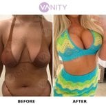 Before and after breast augmentation results at Vanity Cosmetic Surgery Center, fuller bust