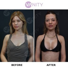 Before and after breast augmentation results at Vanity Cosmetic Surgery Center, enhanced volume
