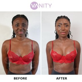Before and after breast augmentation results at Vanity Cosmetic Surgery Center, enhanced volume
