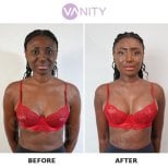 Before and after breast augmentation results at Vanity Cosmetic Surgery Center, enhanced volume