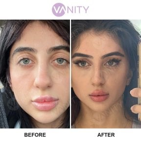 Результаты блефаропластики верхних век до и после в Vanity Cosmetic Surgery Center