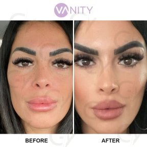 Результаты блефаропластики верхних век до и после в Vanity Cosmetic Surgery Center