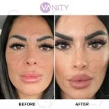 Результаты блефаропластики верхних век до и после в Vanity Cosmetic Surgery Center