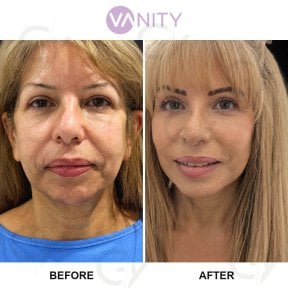 Результати пластики верхніх повік до і після у Vanity Cosmetic Surgery Center, омолоджений вигляд