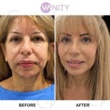Результати пластики верхніх повік до і після у Vanity Cosmetic Surgery Center, омолоджений вигляд