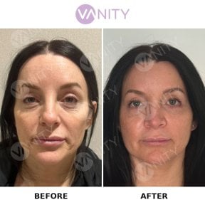 Результати пластики верхніх повік до і після у Vanity Cosmetic Surgery Center
