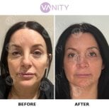 Результати пластики верхніх повік до і після у Vanity Cosmetic Surgery Center