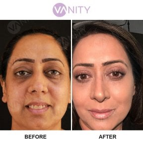 Результати пластики верхніх повік до і після у Vanity Cosmetic Surgery Center, омолодження