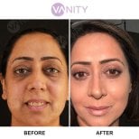 Результати пластики верхніх повік до і після у Vanity Cosmetic Surgery Center, омолодження