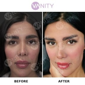 Результаты блефаропластики верхних век до и после в Vanity Cosmetic Surgery Center