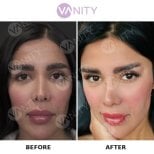 Результаты блефаропластики верхних век до и после в Vanity Cosmetic Surgery Center