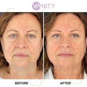 Результати пластики верхніх повік до і після у Vanity Cosmetic Surgery Center, омолодження