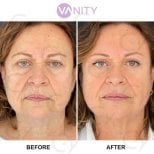 Результати пластики верхніх повік до і після у Vanity Cosmetic Surgery Center, омолодження