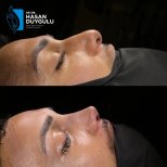 Résultats avant/après septoplastie à la clinique Dr. Hasan Duygulu, profil nasal amélioré