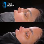 Résultats avant/après septoplastie chez Dr. Hasan Duygulu, profil nasal amélioré