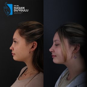 Résultats avant/après septoplastie à la clinique Dr. Hasan Duygulu pour cloison nasale déviée