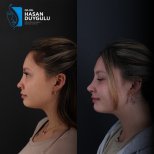 Résultats avant/après septoplastie à la clinique Dr. Hasan Duygulu pour cloison nasale déviée