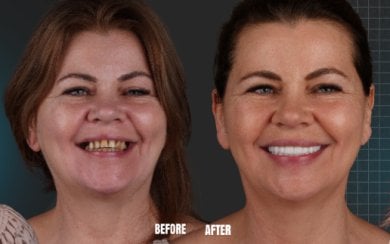 Результат до та після імплантації All-on-4 в Esnan Dental Clinics, покращена посмішка
