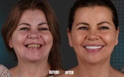 Результат до та після імплантації All-on-4 в Esnan Dental Clinics, покращена посмішка