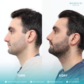 before-after photo sex-reassignment-surgery