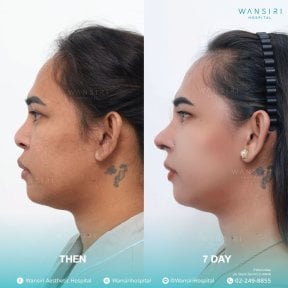 before-after photo sex-reassignment-surgery