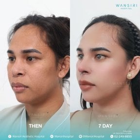 before-after photo sex-reassignment-surgery
