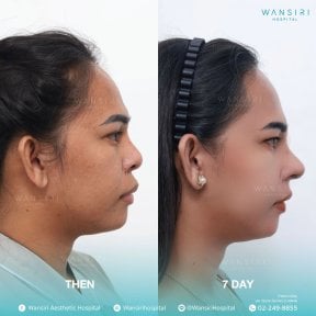 before-after photo sex-reassignment-surgery