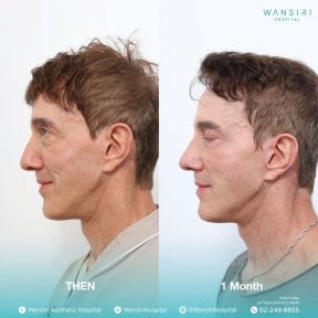 before-after photo sex-reassignment-surgery