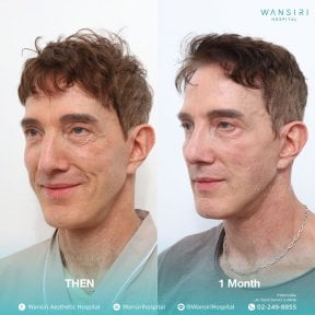 before-after photo sex-reassignment-surgery