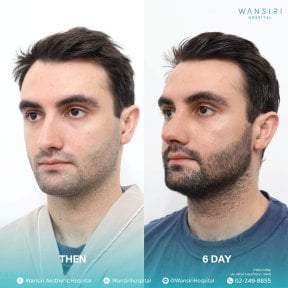 before-after photo sex-reassignment-surgery