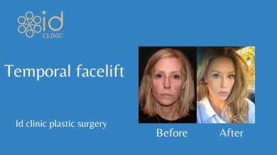before-after photo breast-implant-revision