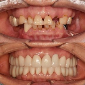 نتيجة قبل وبعد زراعة الأسنان All-on-4 في 365 Seoul OneTop Dental Clinic، استعادة الابتسامة الكاملة