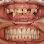 نتيجة قبل وبعد زراعة الأسنان All-on-4 في 365 Seoul OneTop Dental Clinic، استعادة الابتسامة الكاملة