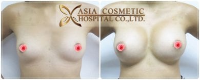 before-after photo breast-implant-revision