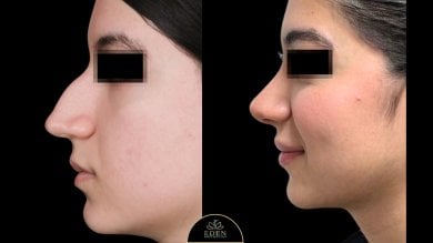 before-after photo rhinoplasty-nose-job