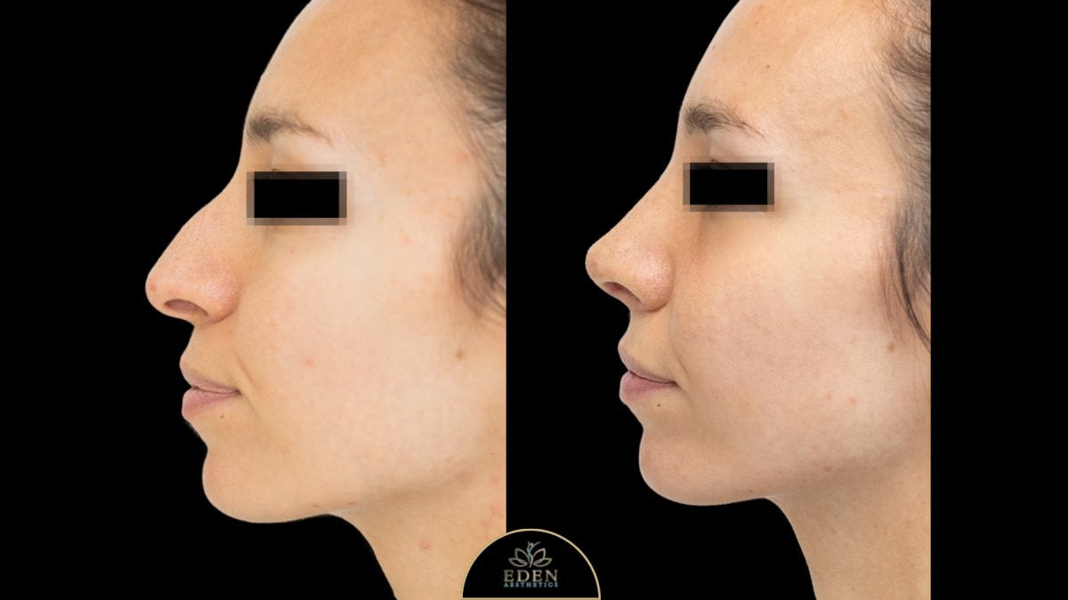 نتائج عملية تجميل الأنف قبل وبعد في EDEN AESTHETICS، إعادة تشكيل طبيعية للأنف