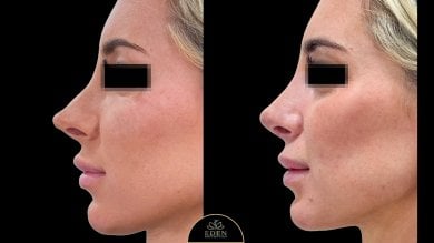 before-after photo rhinoplasty-nose-job