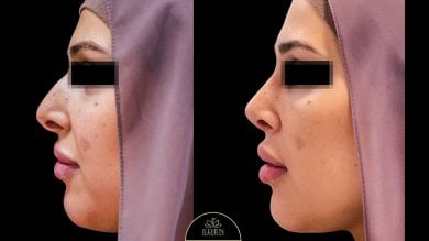 before-after photo rhinoplasty-nose-job