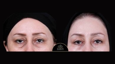 before-after photo blepharoplasty-eyelid