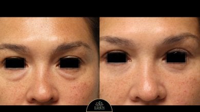 before-after photo blepharoplasty-eyelid