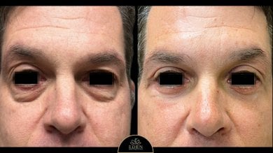 before-after photo blepharoplasty-eyelid