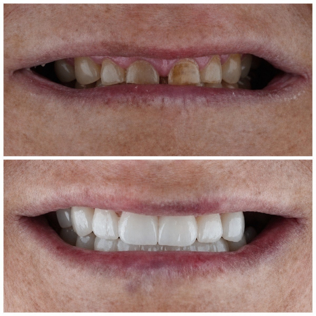 Resultados antes y después de implantes All-on-4 en Nifa Dent International, restauración de sonrisa