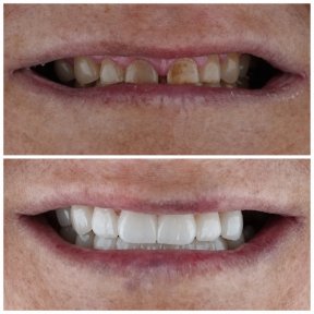 before-after photo all-on-4-dental-implants