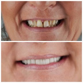 before-after photo all-on-4-dental-implants