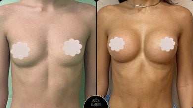 before-after photo breast-augmentation