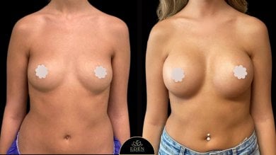 before-after photo breast-augmentation