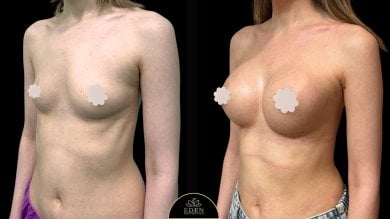 before-after photo breast-augmentation