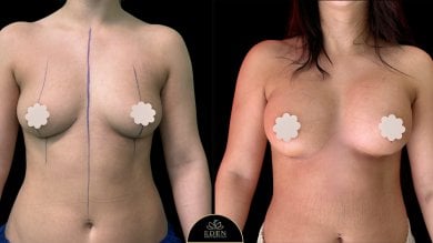 before-after photo breast-augmentation