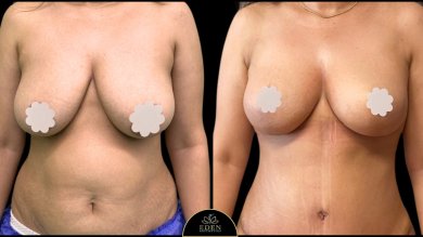 before-after photo mommy-makeover